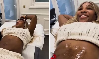 Serena Williams Reveals Tummy-Tightening Procedure but Says 'I Will Always Love My Birthing Scars'