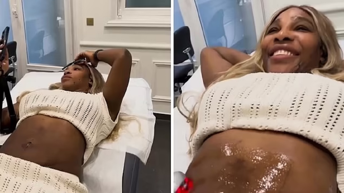 Serena Williams Reveals Tummy-Tightening Procedure but Says 'I Will Always Love My Birthing Scars'